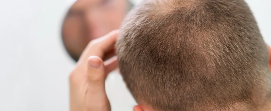 Cuánto dura la micropigmentación capilar y cuándo suele necesitar mantenimiento