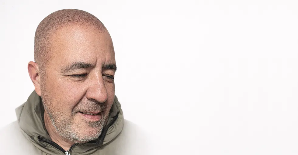 Micropigmentación Capilar. Efecto Rapado