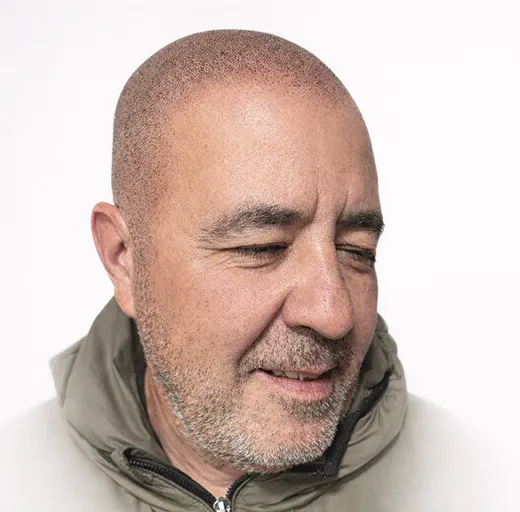 Hombre calvo con tatuaje capilar