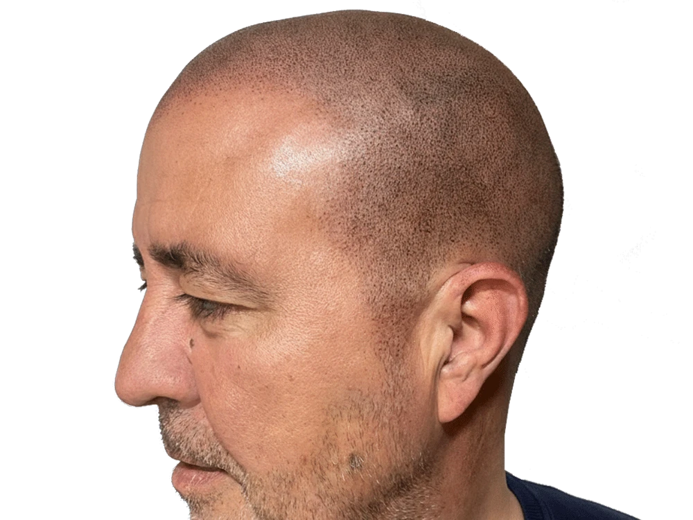 Micropigmentación capilar efecto rapado, después