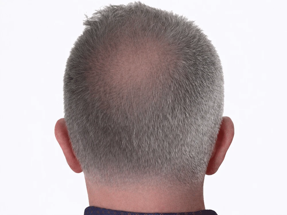 Micropigmentación capilar coronilla, antes