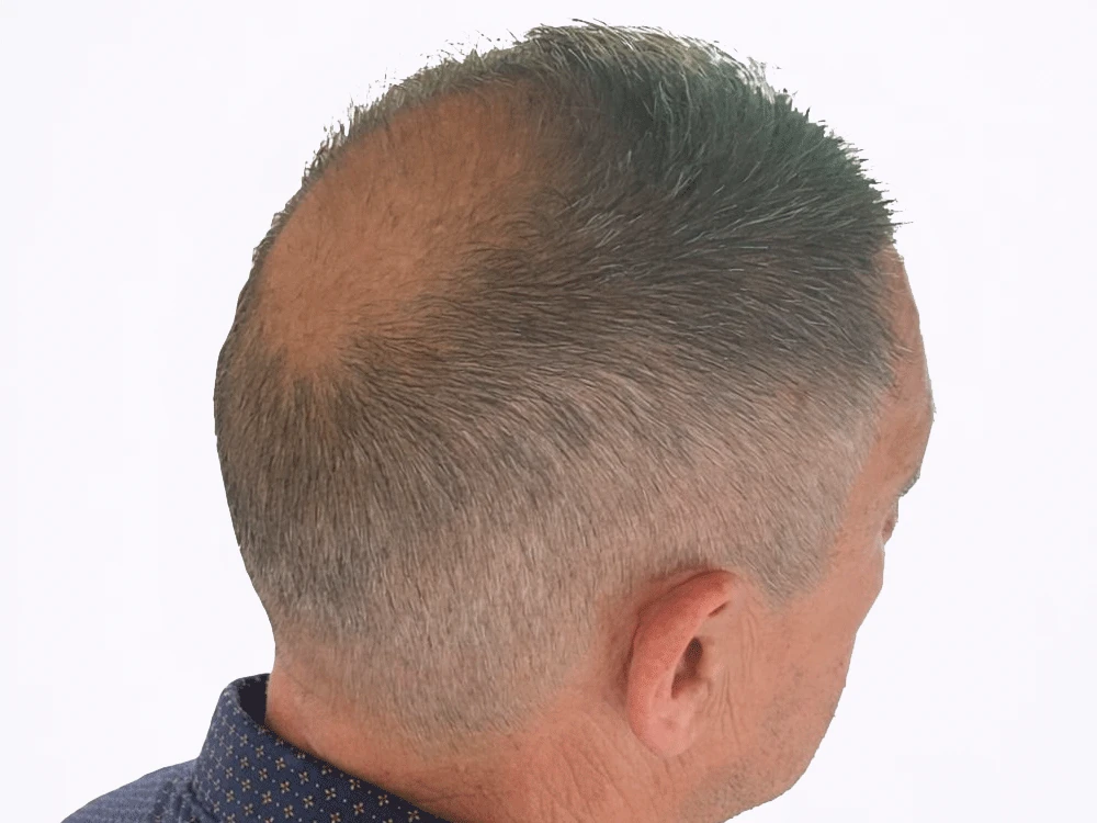 Micropigmentación capilar coronilla, antes