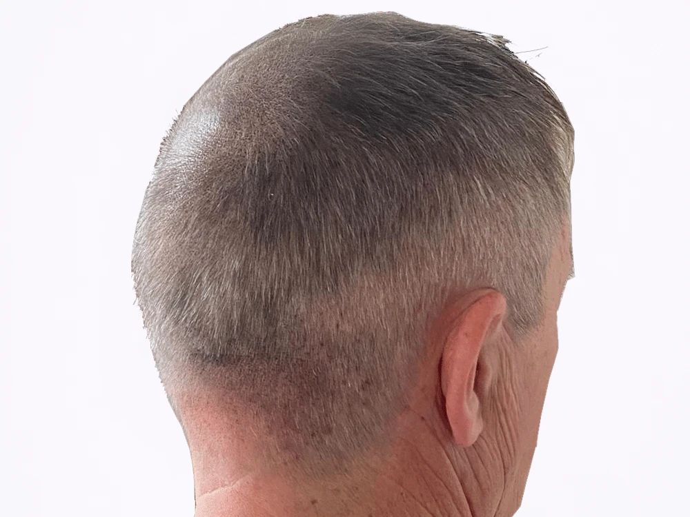 Micropigmentación capilar coronilla, después