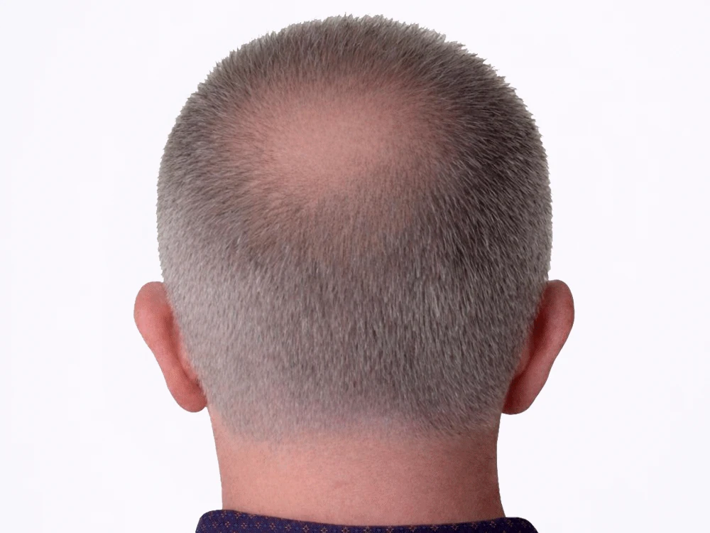 Micropigmentación capilar coronilla, antes