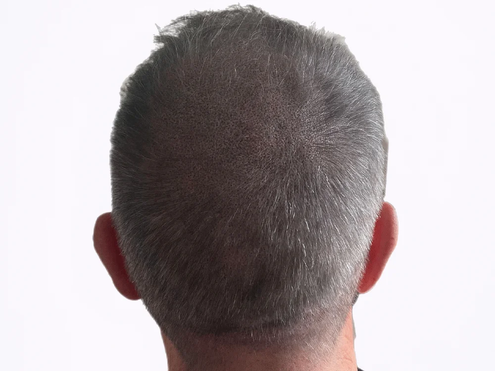 Micropigmentación capilar coronilla, después