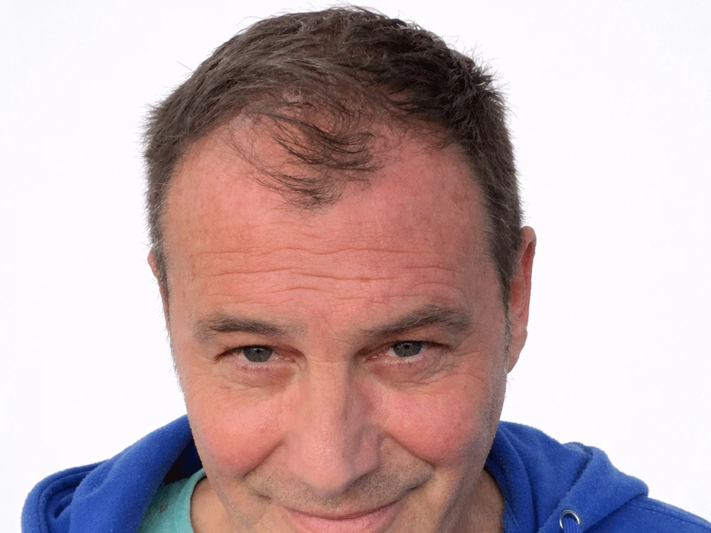 Tatuaje capilar densidad visual, antes