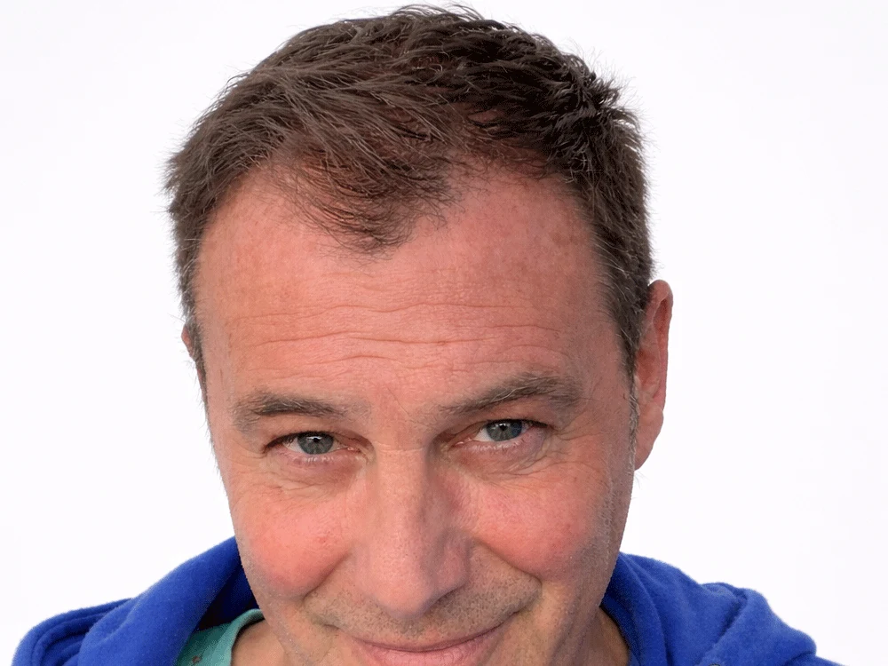 Tatuaje capilar densidad visual, después