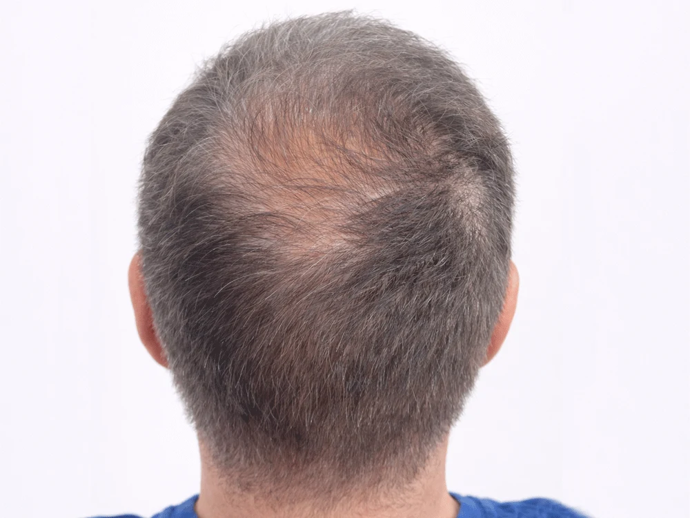 Micropigmentación capilar coronilla, antes