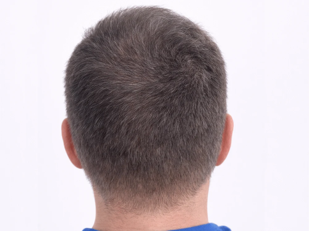 Micropigmentación capilar coronilla, después