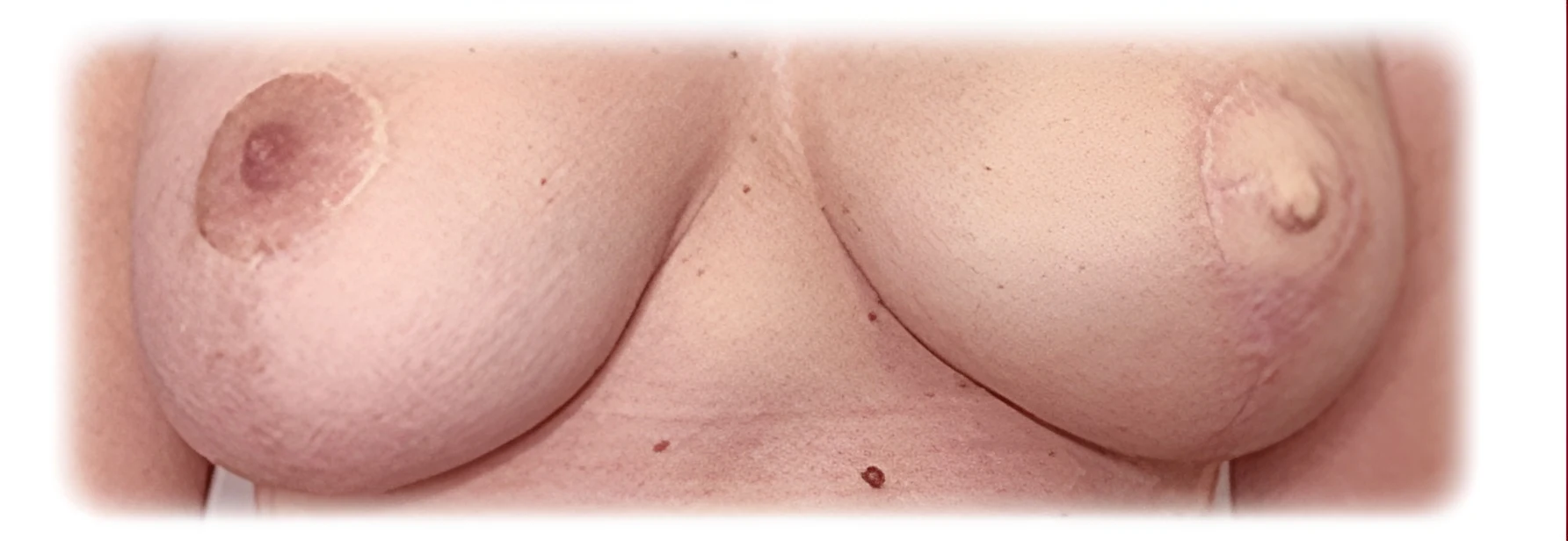 Tatuaje de areola post-mastectomía, antes