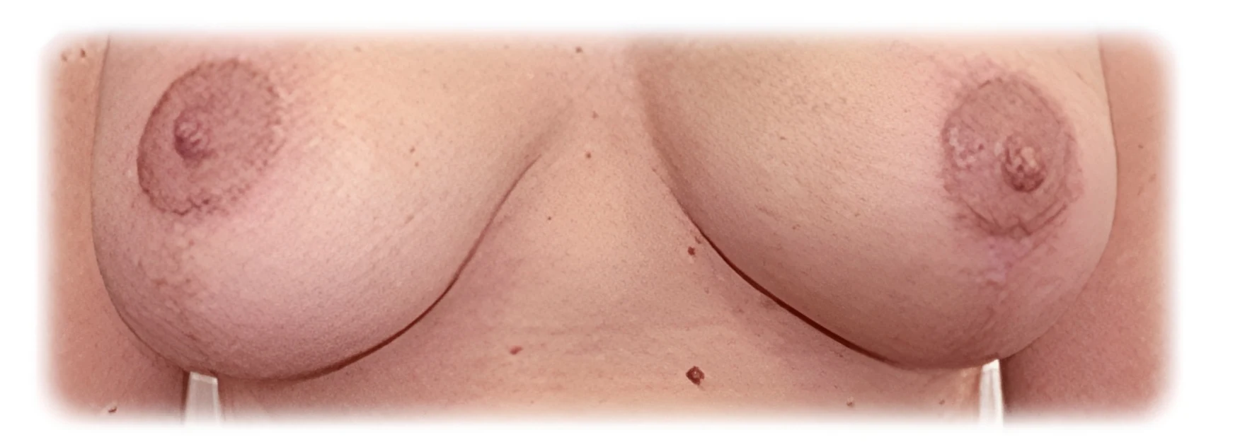 Tatuaje de areola post-mastectomía, después