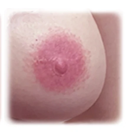 Tatuaje de areola post-mastectomía, después