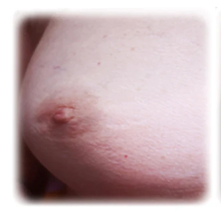 Micropigmentación areolas, antes