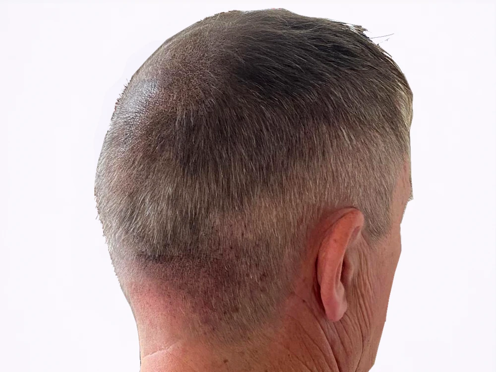 Micropigmentación capilar coronilla, después