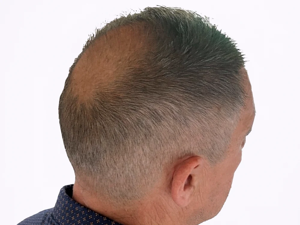 Micropigmentación capilar coronilla, antes